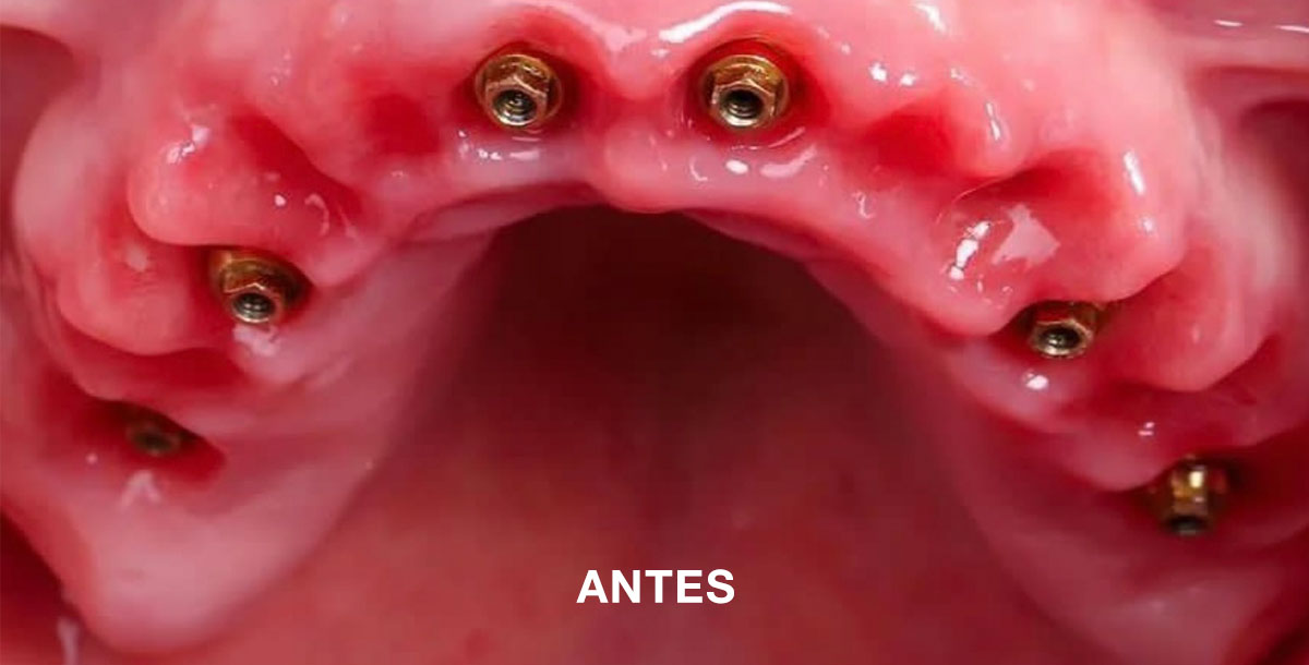1 Antes