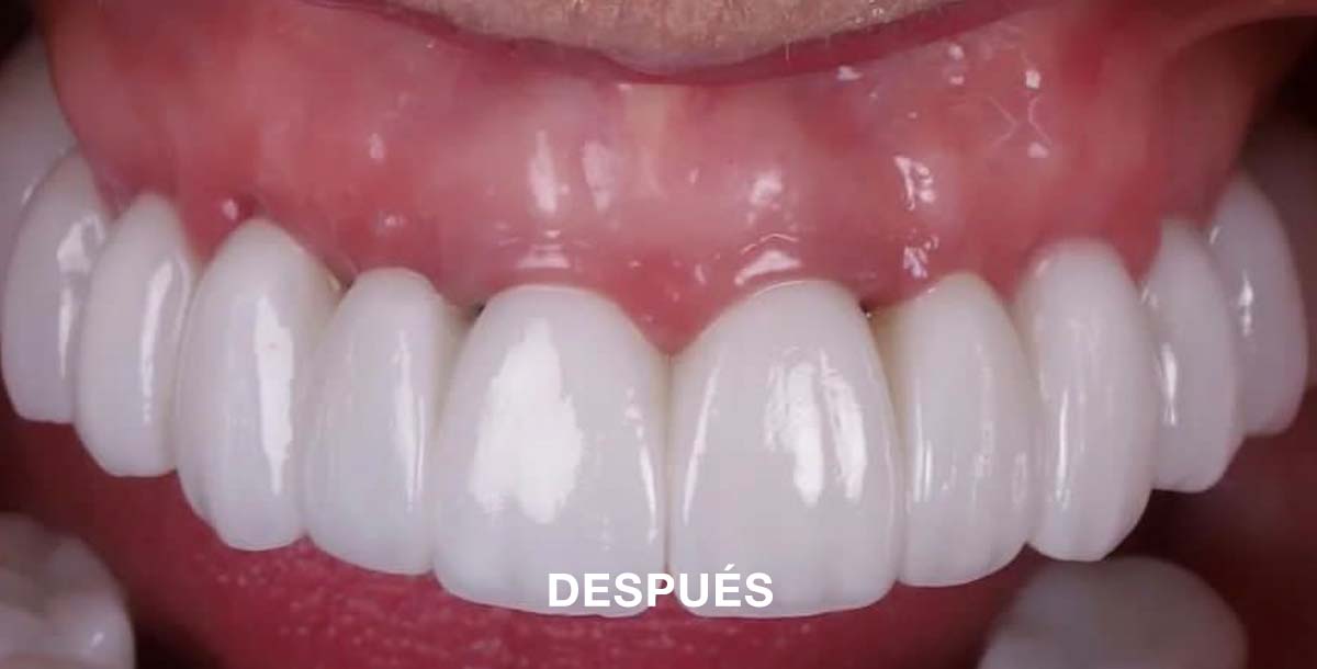 1 Después