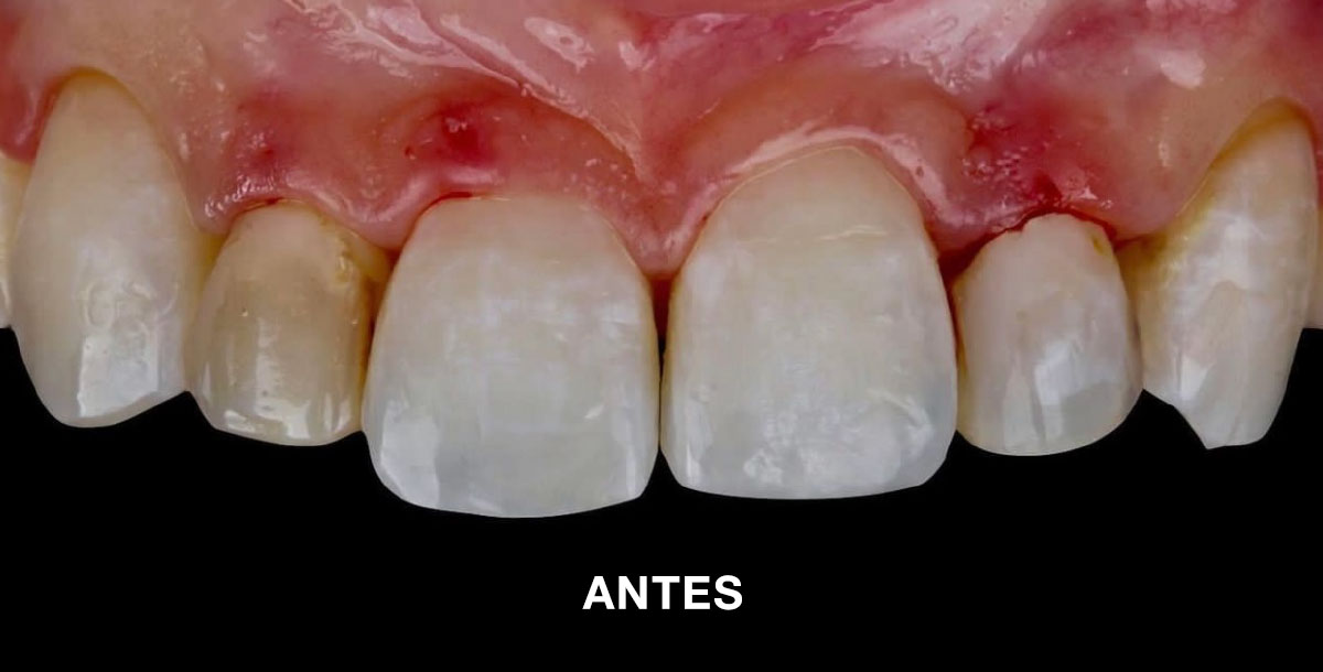 2 Antes